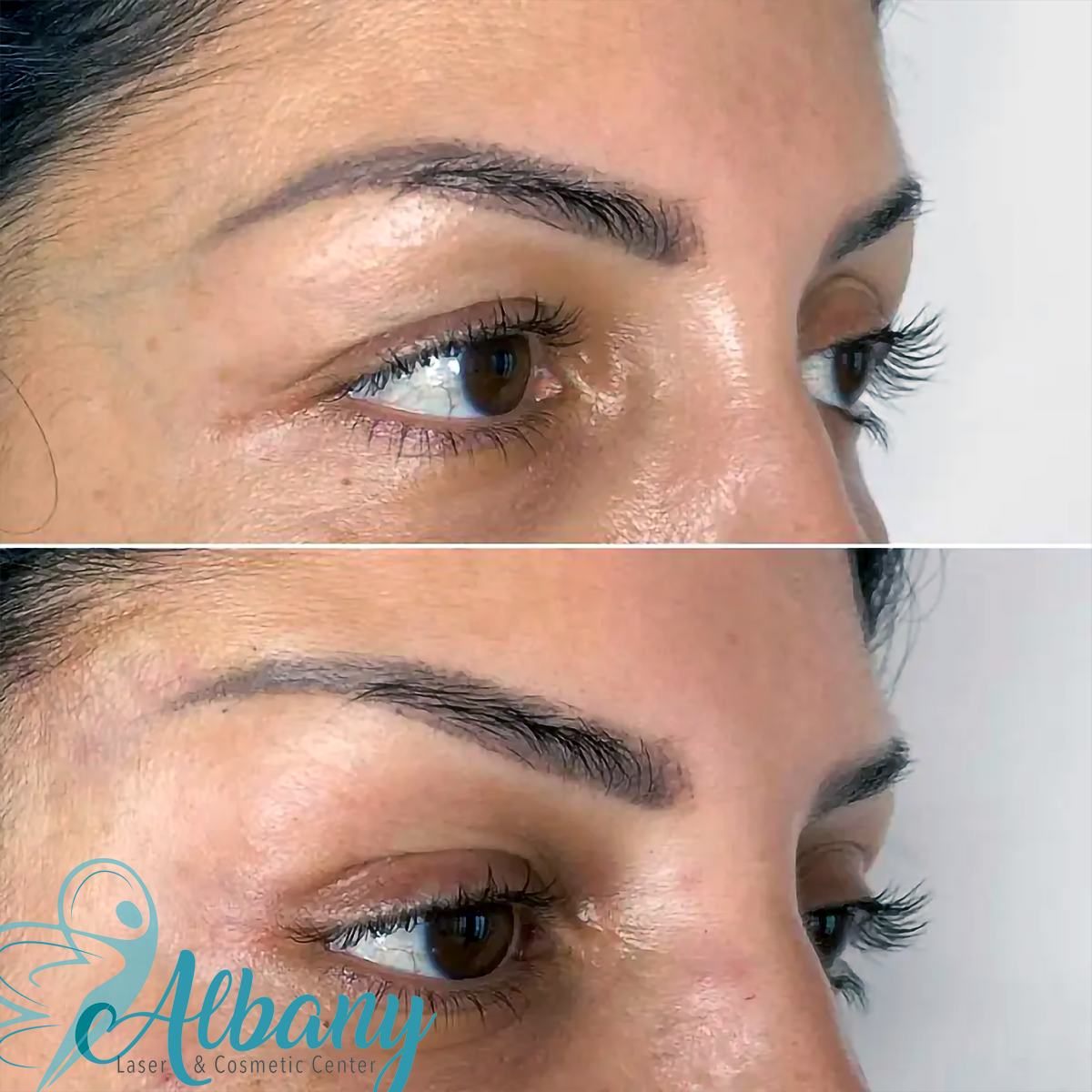 picture showing before and after foxy Brow lift