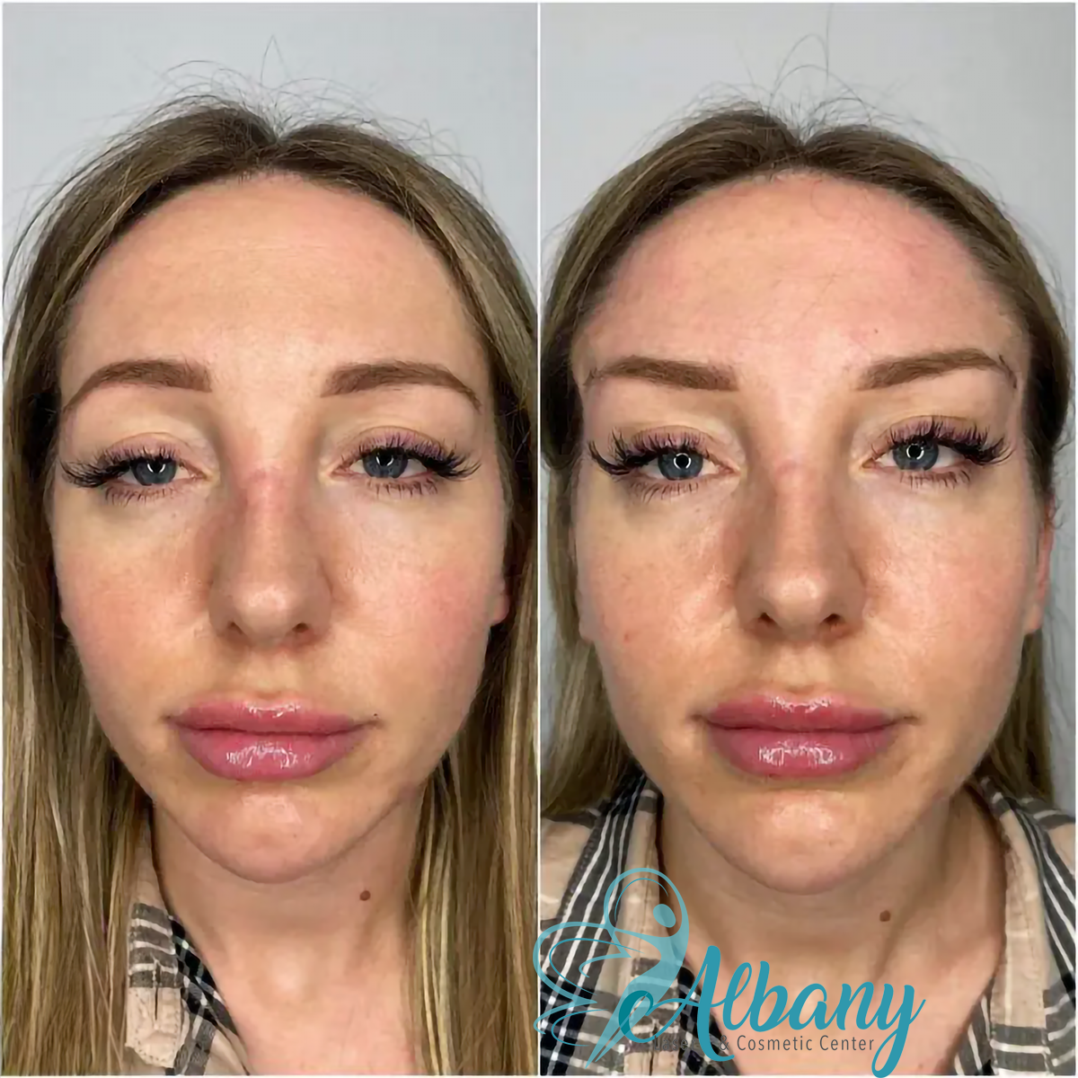 picture showing before and after thread Brow lift