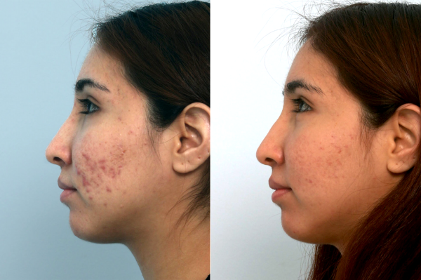 Before and after Fraxel laser treatment showing improved skin texture and less acne scars (side view)