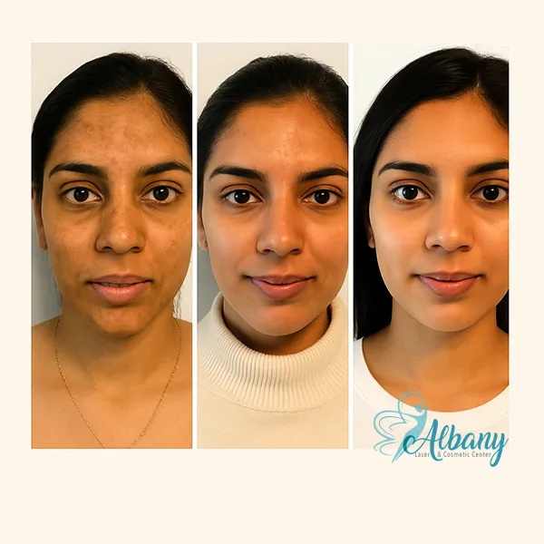 Triptych image showing the skin transformation of an Indian woman after Fraxel laser treatment at Albany Cosmetic and Laser Centre. The first image shows hyperpigmentation and uneven skin tone; the second shows reduced pigmentation and smoother skin; and the third displays a clear, radiant complexion. The clinic logo appears in the bottom right corner