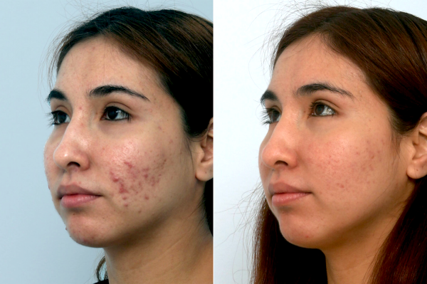 Before and after Fraxel laser treatment showing improved skin texture and less acne scars (oblique view)