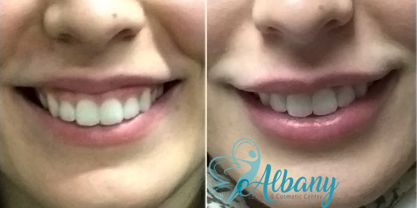 Gummy Smile Treatment Botox Edmonton