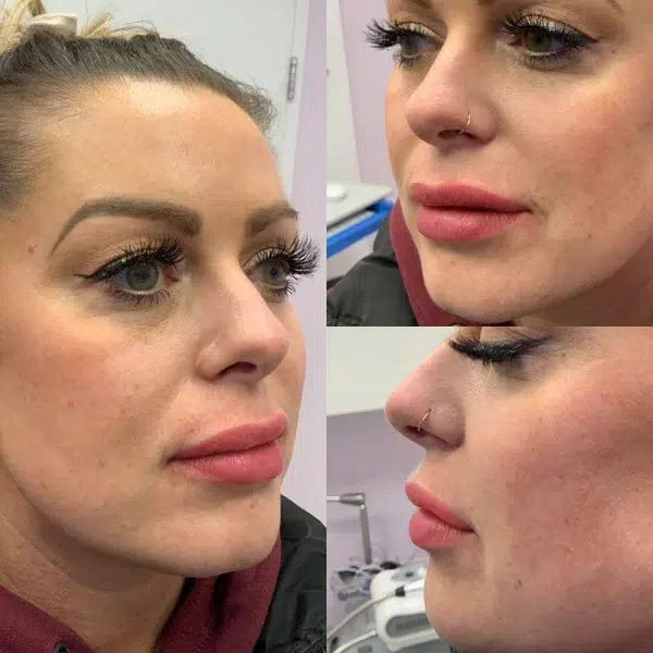Happy clients with lip fillers 1