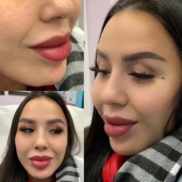 Happy clients with lip fillers