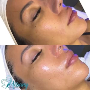 Before and after HydraFacial image highlighting dramatically improved skin hydration, brightness, and healthy glow at Albany Cosmetic and Laser Centre