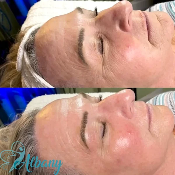 Side-by-side comparison demonstrating significant wrinkle reduction, smoother texture, and glowing skin after HydraFacial treatment at Albany Cosmetic and Laser Centre.