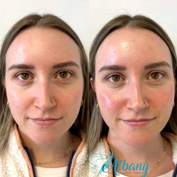 Clear improvement in skin hydration, smoothness, and radiance with a HydraFacial session at Albany Cosmetic and Laser Centre