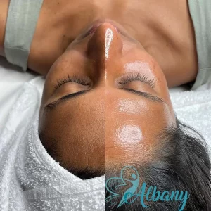 Before and after HydraFacial results showing visibly brighter, hydrated, and refreshed facial skin at Albany Cosmetic and Laser Centre."