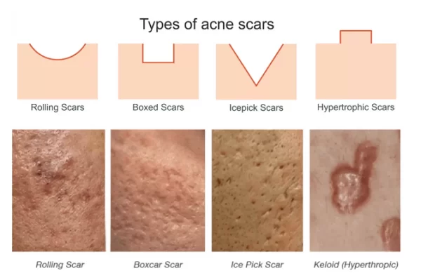Icepick acne scars