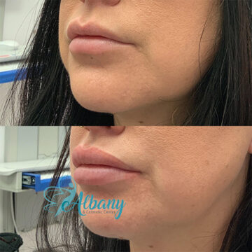 lip fillers results
