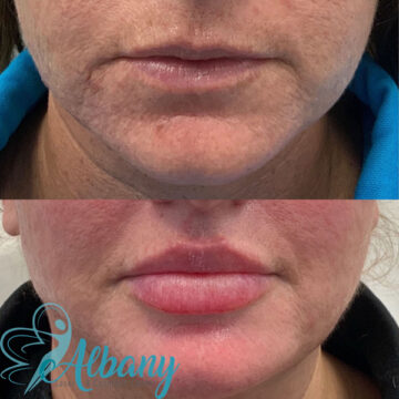 lip augmentation results
