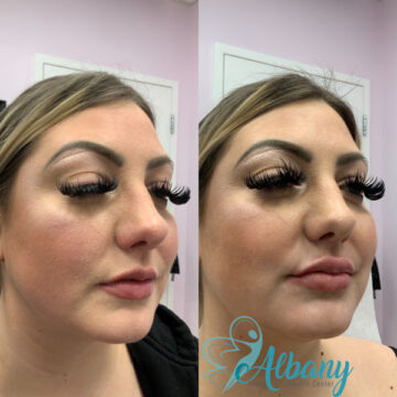 lip fillers edmonton