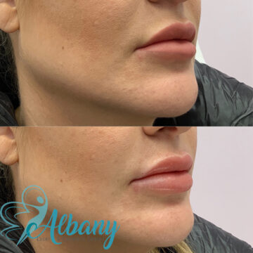lip injections edmonton