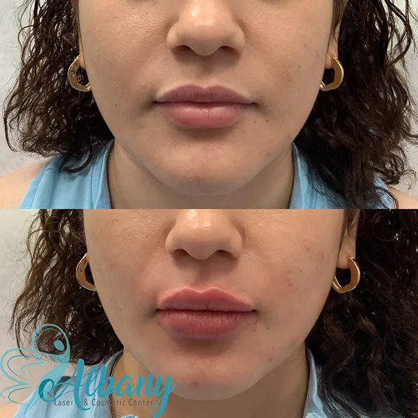 Lip fillers results