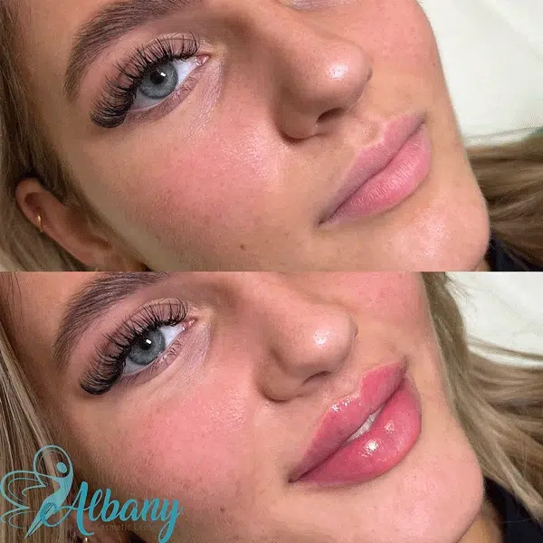 Before and after lip filler treatment showing enhanced lip volume and definition