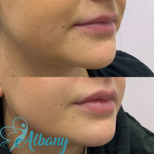 Before and after lip fillers Edmonton