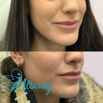botox lip flip