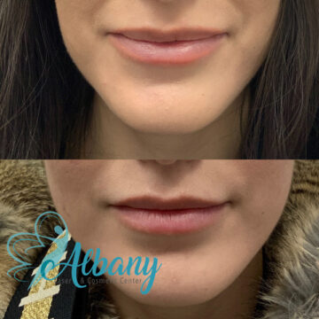 Botox lip flip