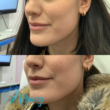 Botx lip injection