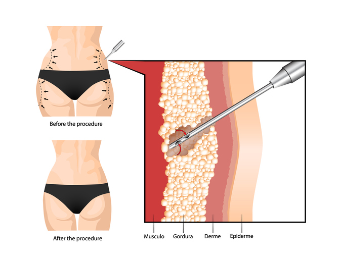 Liposuction Edmonton