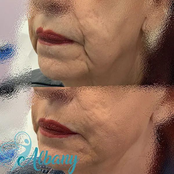 before and after marrionette lines fillers