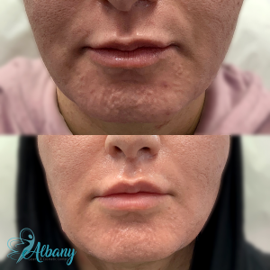 Visible improvement in acne scarring and skin smoothness following microneedling treatment in Edmonton