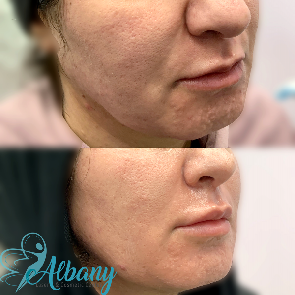 Comparison photo highlighting skin rejuvenation and smoother complexion after microneedling sessions.