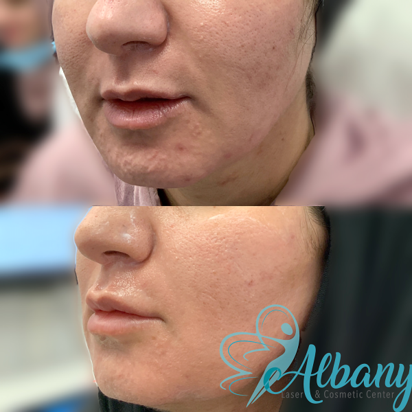 efore and after microneedling treatment showing improved skin texture and reduced acne scars.