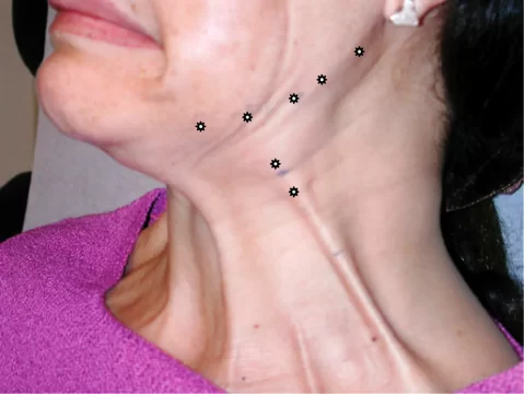 Nefertiti neck lift using Botox