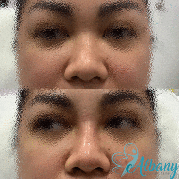 Nose fillers edmonton