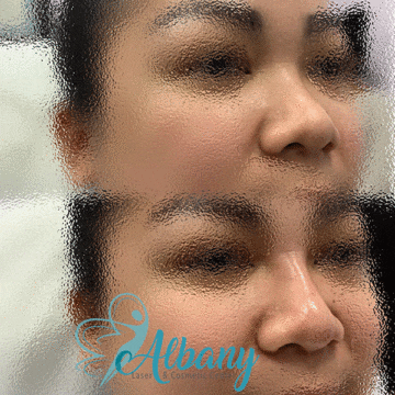 Nose job results Edmonton