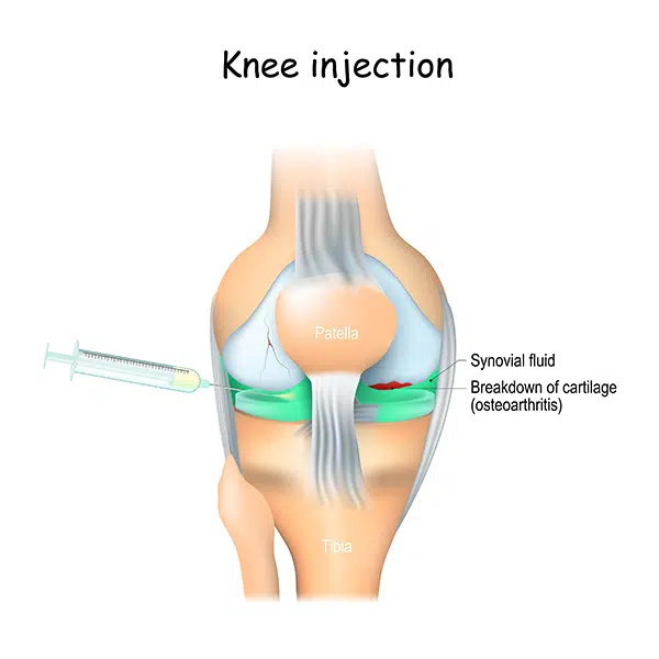 PRP for Knee