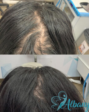 before and after prp
