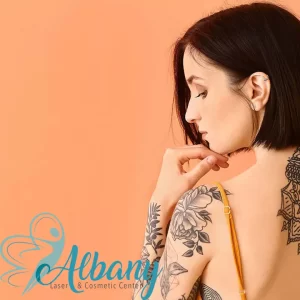 tattoo removal edmonton