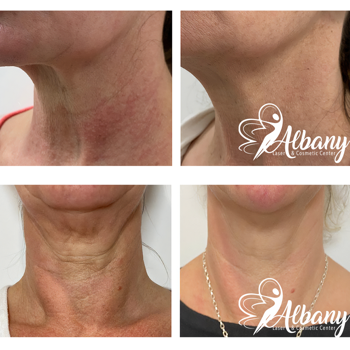 A picture shows the Ultherapy treatment results on the neck