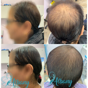 hair loss treatment results edmonton