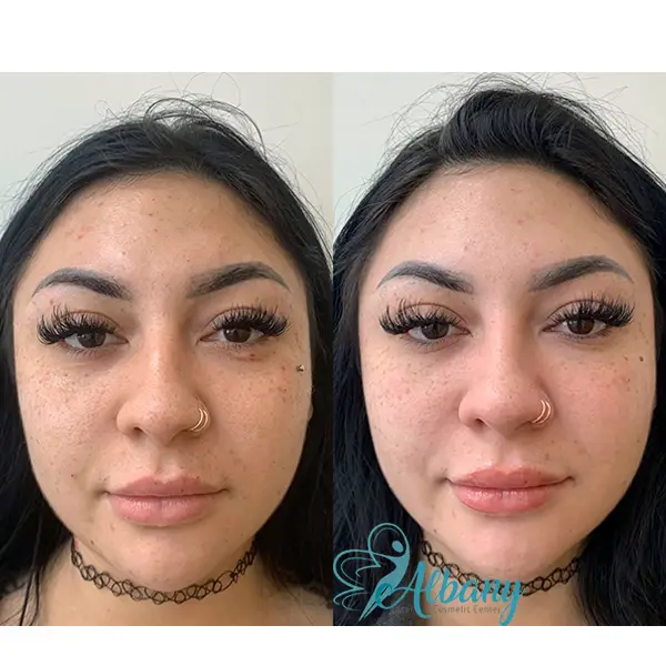 Before and after results of a Vampire Facelift at Albany Cosmetic & Laser Center, showcasing improved skin brightness, hydration, and overall rejuvenation.