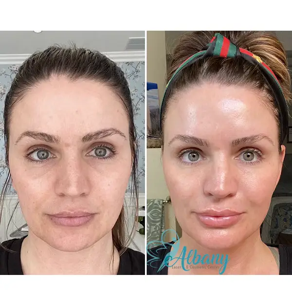 Comparison images before and after Vampire Facelift treatment, highlighting enhanced skin smoothness, reduced imperfections, and a refreshed appearance at Albany Cosmetic & Laser Center.