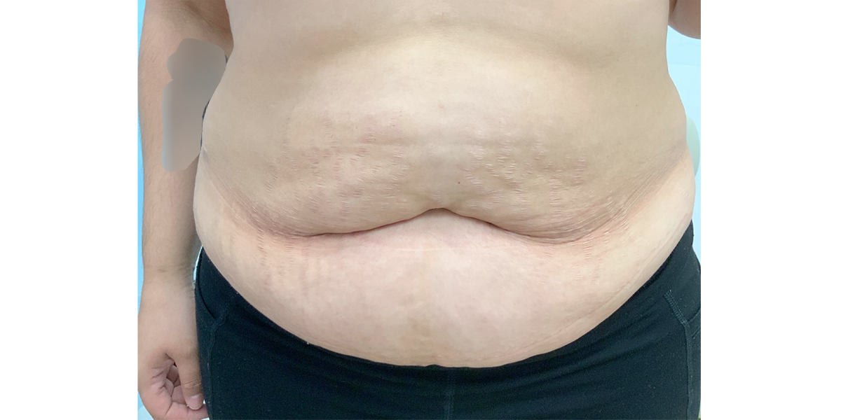 a picture that shows abdominal fat before liposuction