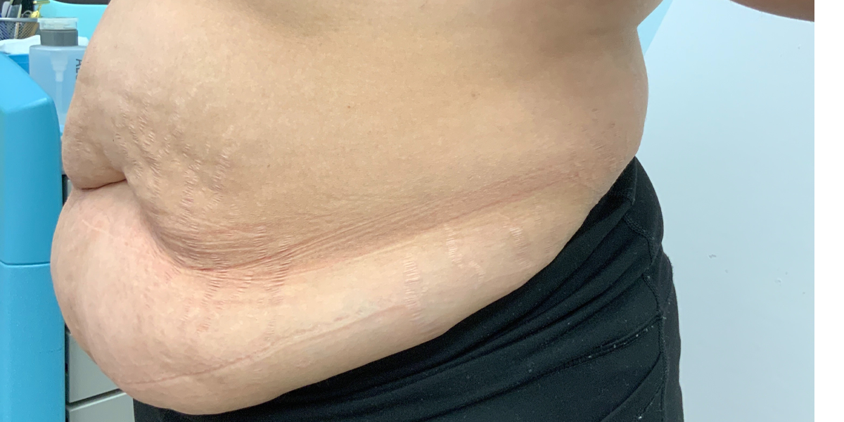 a picture that shows abdominal fat before liposuction