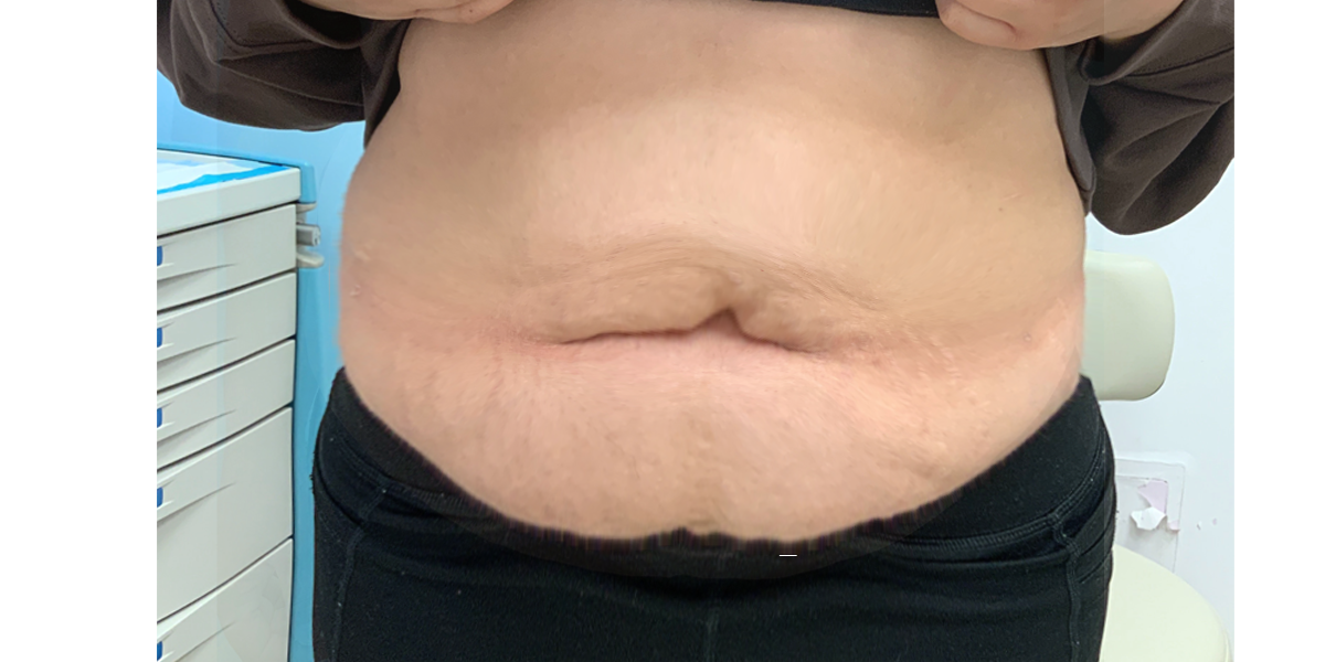 a picture that shows reduction in abdominal fats after liposuction