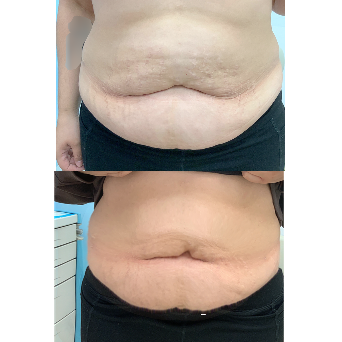 a picture that shows the liposuction results