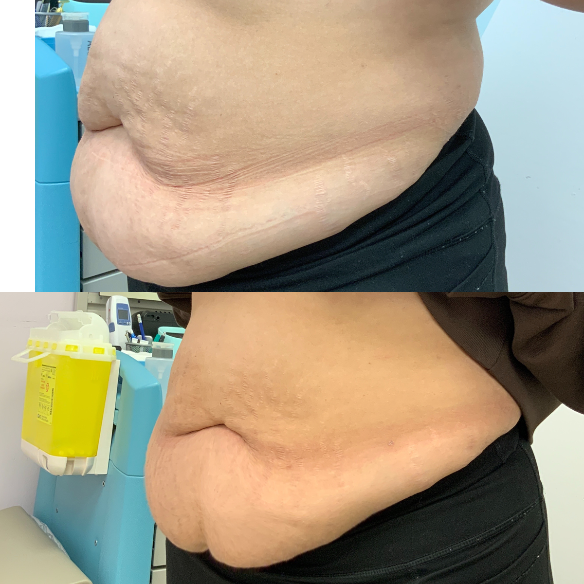 a picture that shows the Vaser liposuction results Edmonton