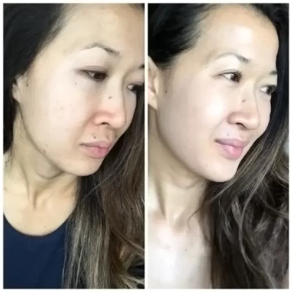 ZO-Skin-Health-Before-After