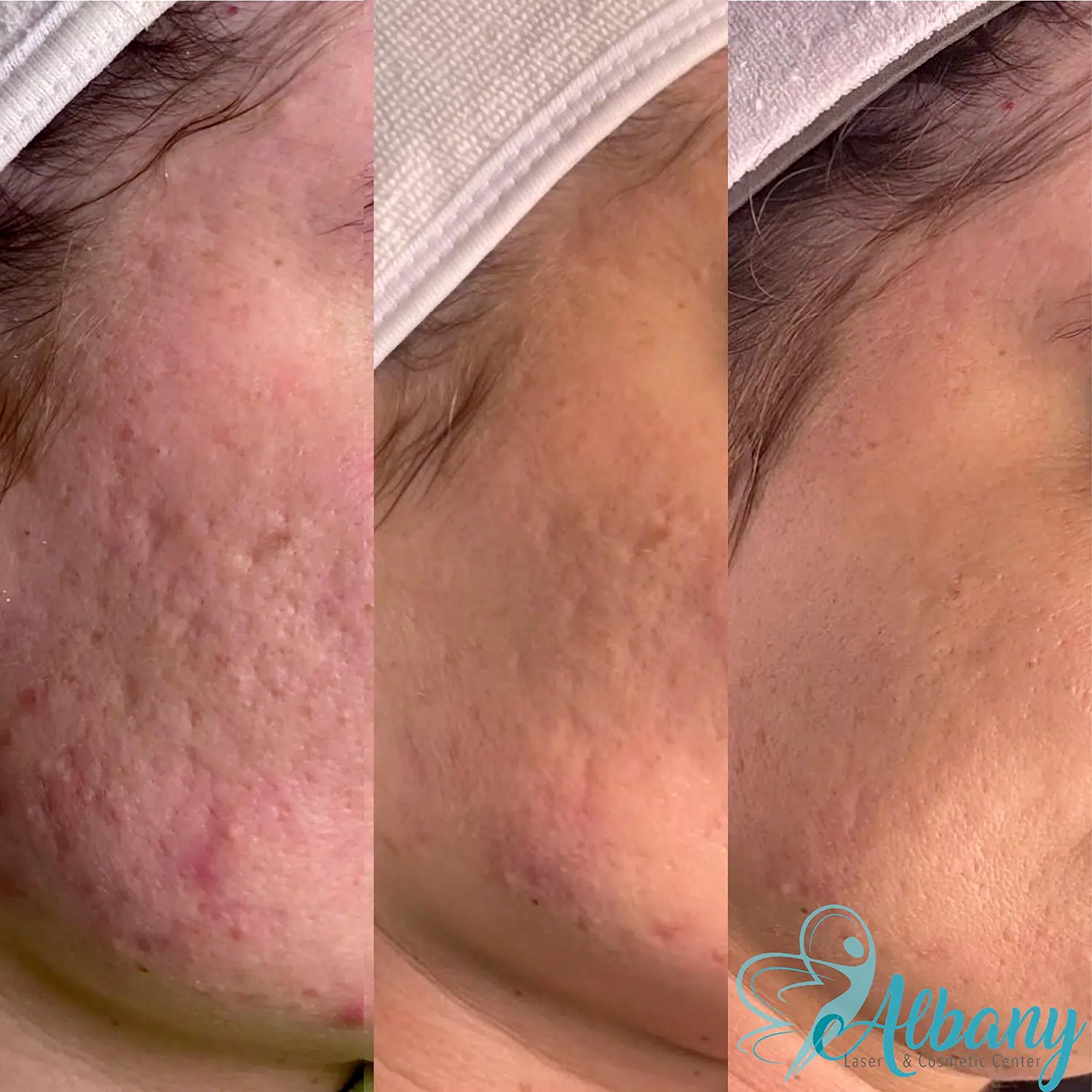 acne scars treatment edmonton