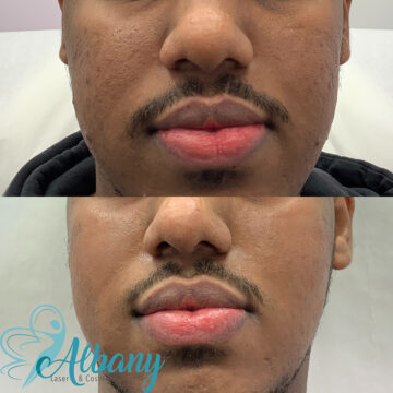acne scars correction edmonton