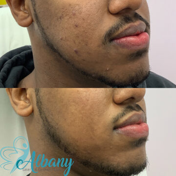 acne scars treatment edmonton