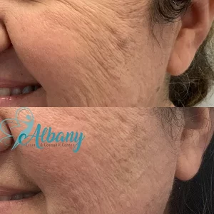 acne scars treatment results