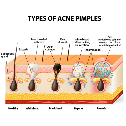 acne types