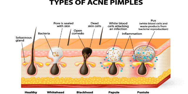 acne types infograph